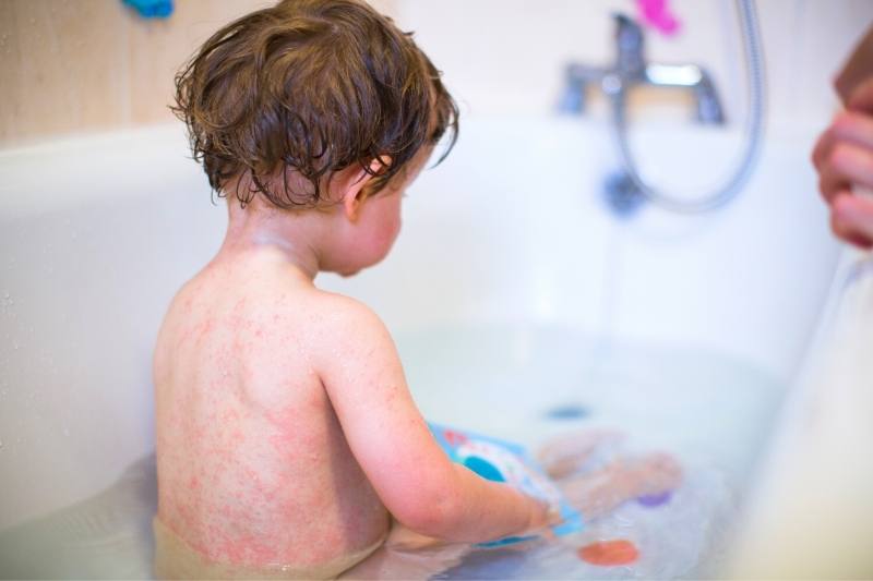 Oatmeal bath for rash