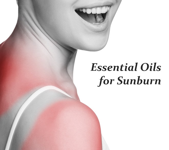 essential oils for sunburn