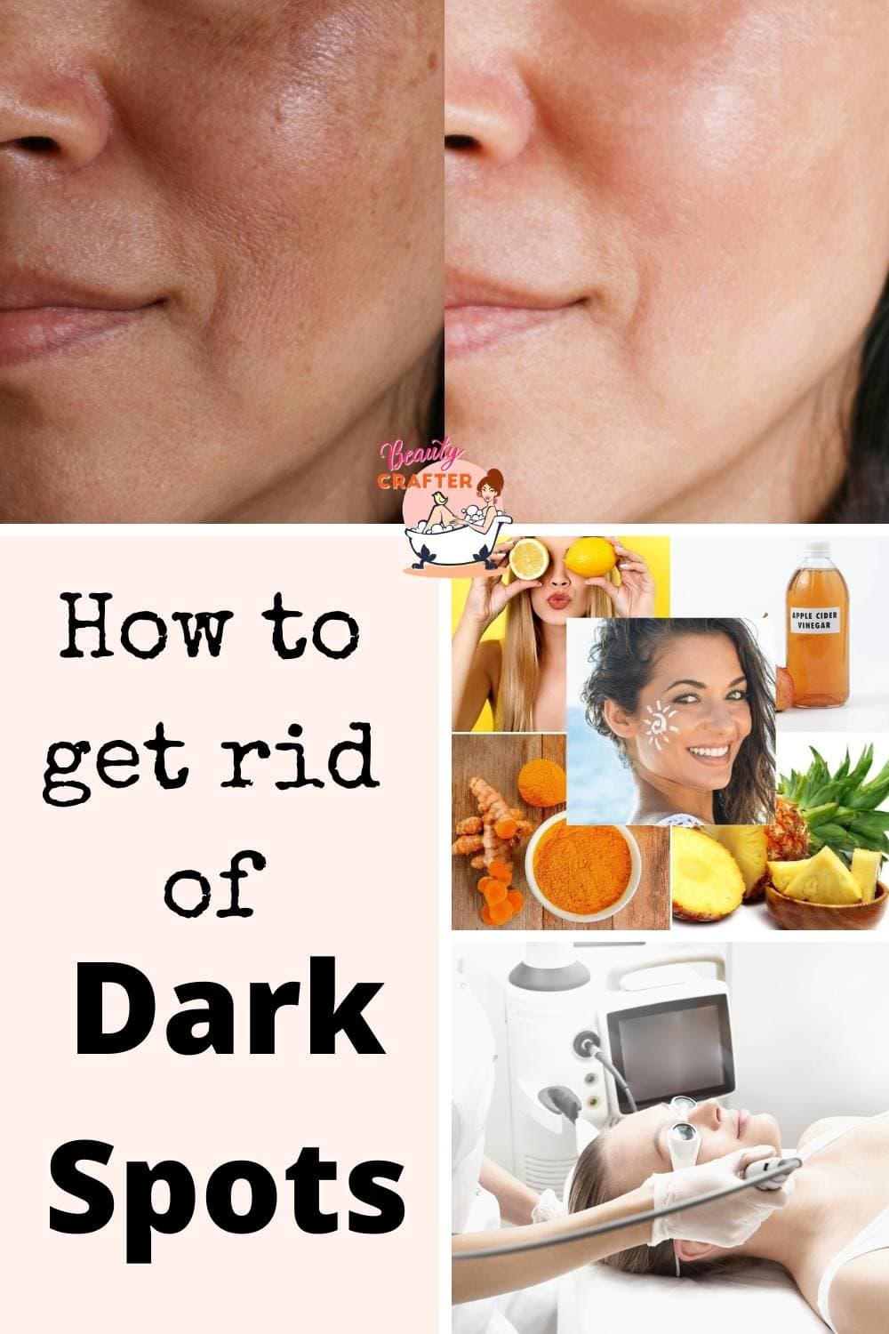 How Do You Get Rid Of Dark Spots Fast Naturally