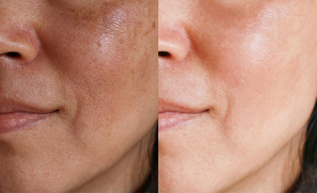 How Can You Get Rid Of Dark Spots On Skin