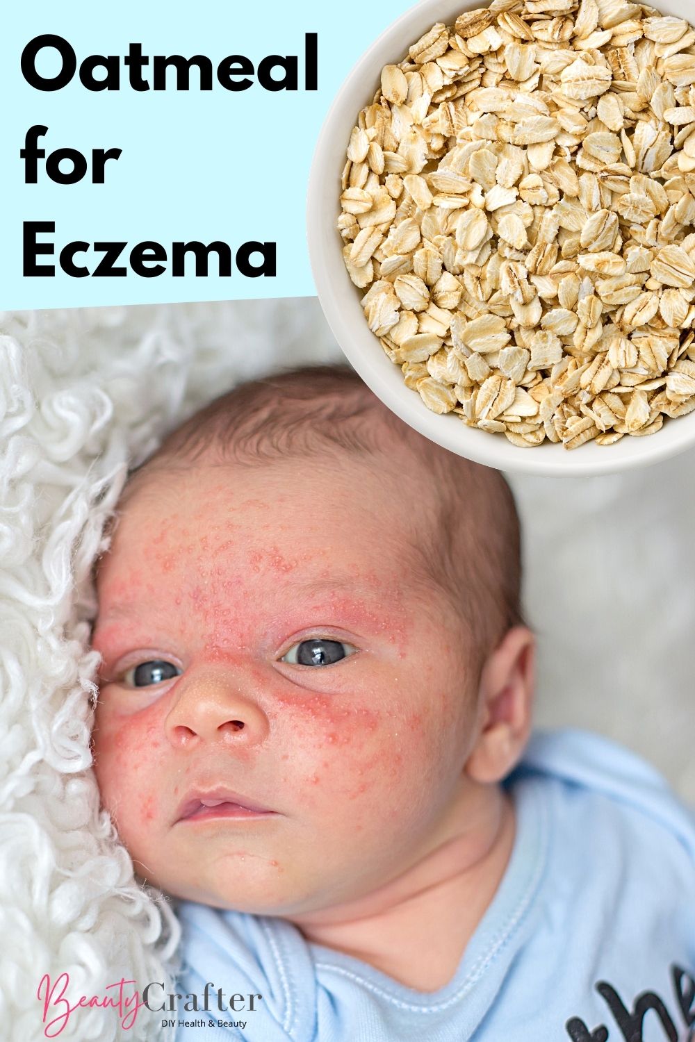 Ask the experts: colloidal oatmeal and baby eczema