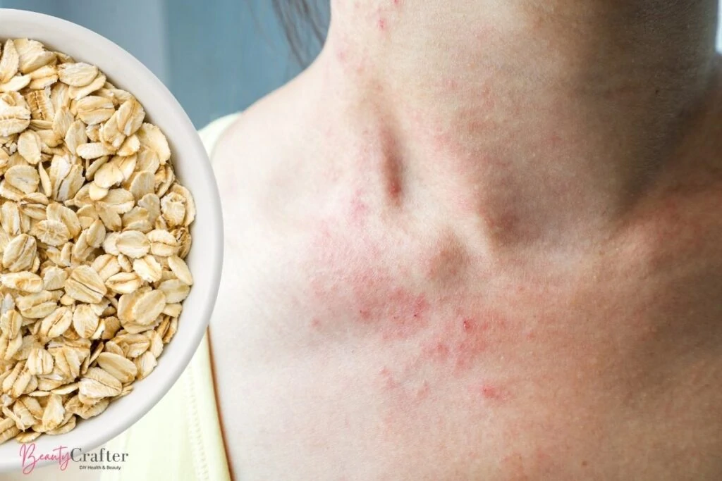 oatmeal for eczema shown next to woman with irritated skin.